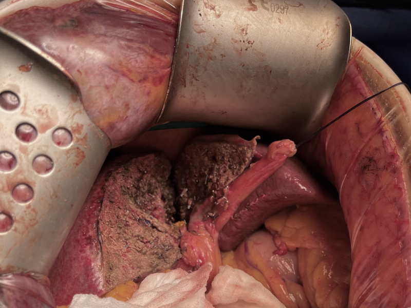 Hepatectomy clinical photo