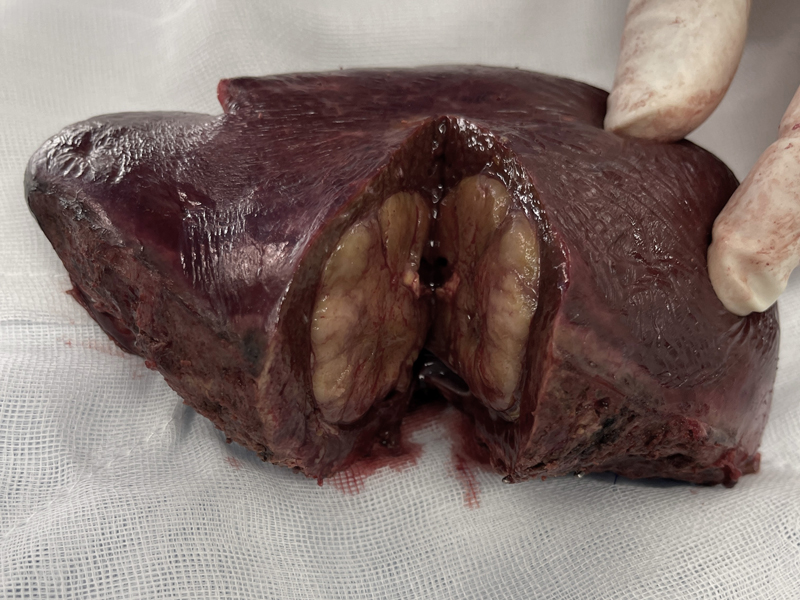 Hepatocellular carcinoma (specimen photo)
