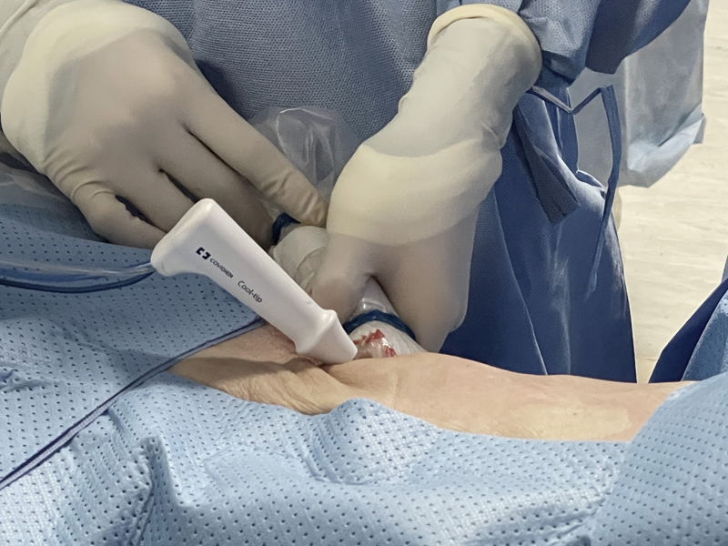 Percutaneous RFA