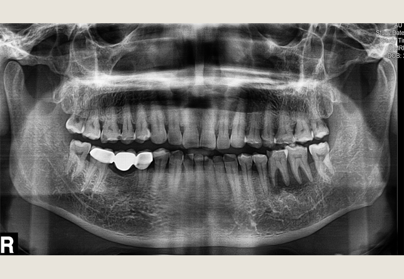 The cancer has invaded mandible