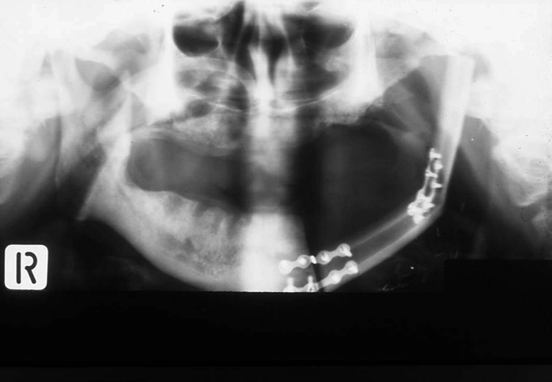 Postoperative x ray of reconstructed mandible