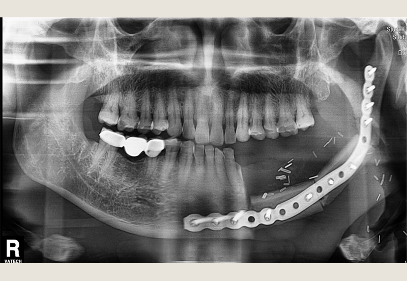 Postoperative x ray of reconstructed mandible 