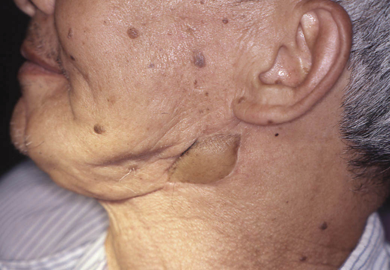 Postoperative photo depicting healed orocutaneous fistula
