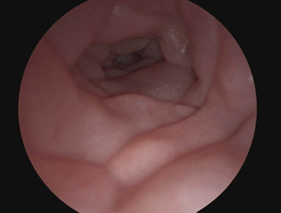 Hypopharynx cancer with neopharynx recontruction with free jejunal garft