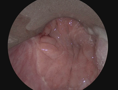 Rigid endoscopy of neopharynx for voice prosthesis insertion