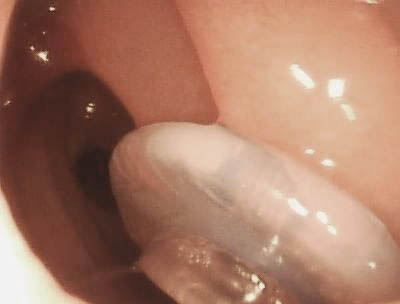 Voice prostesis inserted