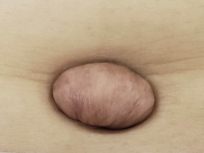 Umbilical keloid
