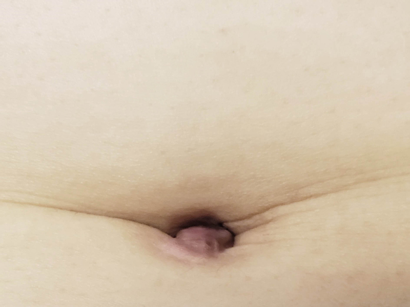Keloid almost completely vanished after intra-lesional cryotherapy with liquid nitrogen.